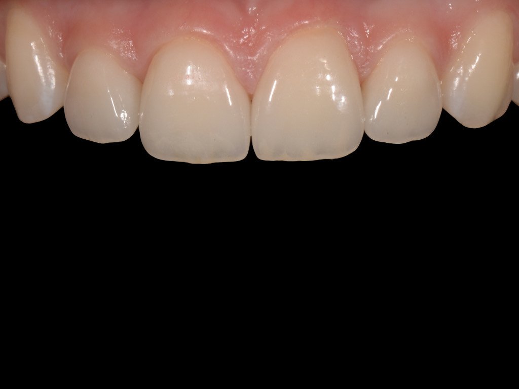 After: the gap closed by orthodontic treatment and the upper front teeth reshaped with IPS e.max ceramic veneers