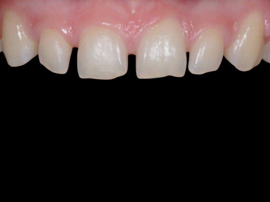 Before: upper front teeth with a central gap and worn edges